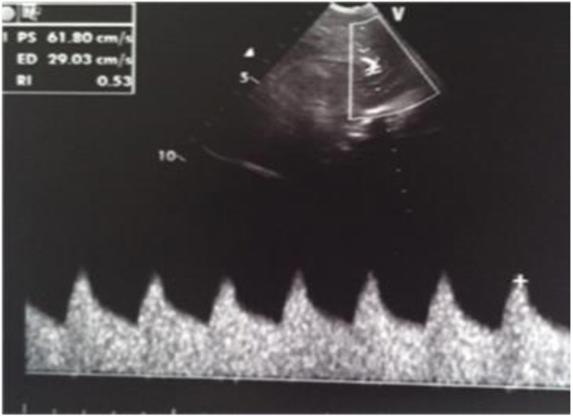 Group B Streptococcal Meningitis: A Description of Six Case Reports ...