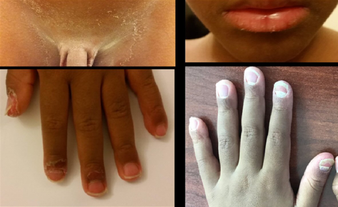 Peeling Fingertips Causes, Treatments, and When to See a Doctor